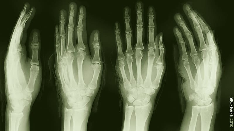 Hand, X Ray, graphy, Medical, X Ray Vision, HD wallpaper