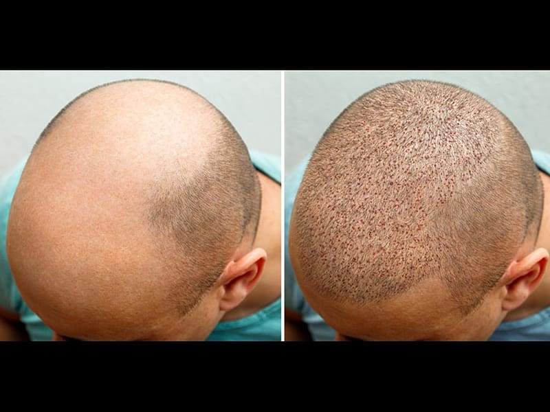 Hair Restoration, PRP therapy, best Scalp Micropigmintation, Hair treatment, HD wallpaper