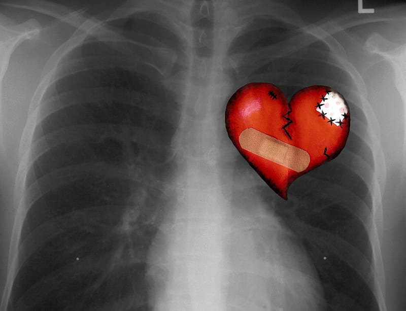 Chest x Ray, chest, x ray, broken heart, heart, HD wallpaper