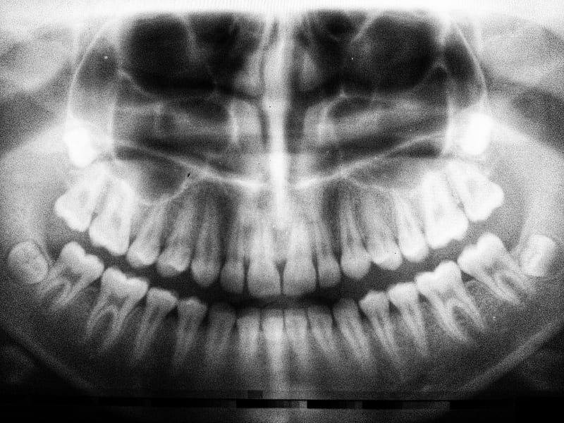 teeth X-ray, HD wallpaper