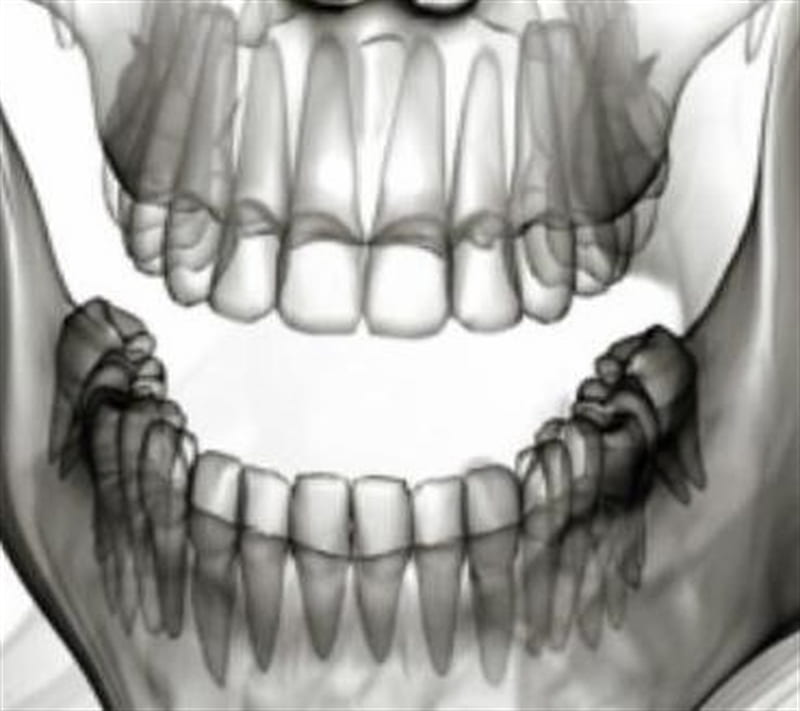 X-ray Teeth, bones, jaw, skull, HD wallpaper