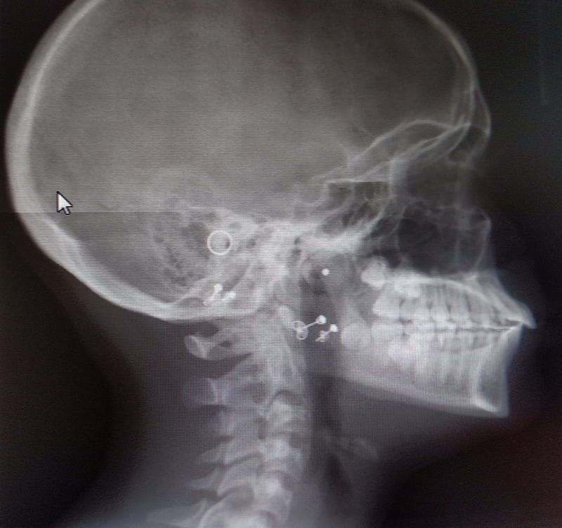 X-ray, skull, xray, HD wallpaper